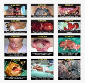 12 Pictorial Health Warning Images - Cigarettes Pictures In Malaysia, HD Png Download, Free Download