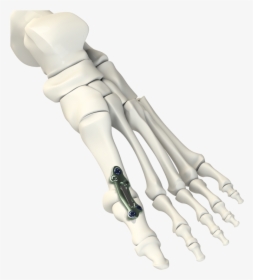 Mpj Implant System - Hand, HD Png Download, Free Download