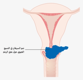 Diagram Showing Stage 2b Cervical Cancer Cruk 216-ar - Cervical Cancer Png, Transparent Png, Free Download