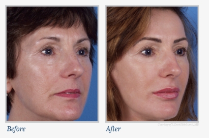 Now Available To The General Public - Laser Skin Treatment Before And After, HD Png Download, Free Download