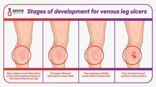 Stages Of Developement For Venous Leg Ulcers - Early Stage Venous Leg Ulcer, HD Png Download, Free Download