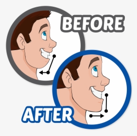 Transparent Braces Drawing Ear - Orthognathic Surgery Cartoon, HD Png Download, Free Download