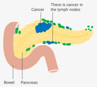 Pancreatic Cancer Risk Linked To Changes In Mouth Bacteria, HD Png Download, Free Download
