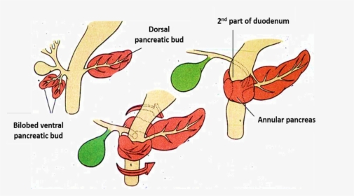 Pancreas - Annular - Annular Pancreas Vs Normal, HD Png Download, Free Download
