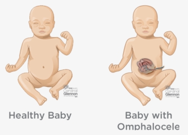 Omphalocele - Bladder Outlet Obstruction, HD Png Download, Free Download