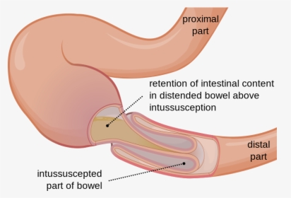 Bowel Intussusception, HD Png Download, Free Download