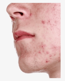 Close Up Of Acne On Man"s Chin - Bcaa Side Effects, HD Png Download, Free Download