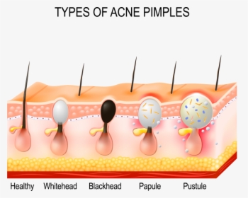 Types Of Acne Cartoon, HD Png Download, Free Download
