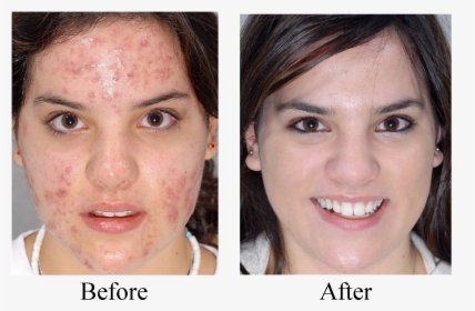 Castor Oil Before And After Skin, HD Png Download, Free Download