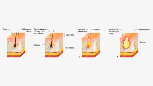 Inside A Pimple, HD Png Download, Free Download