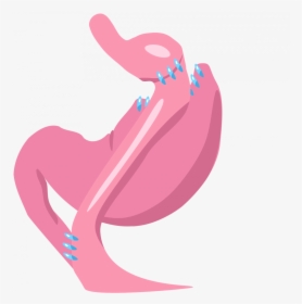 Gastric Bypass, HD Png Download, Free Download