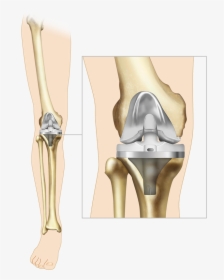 Knee Implant, HD Png Download, Free Download