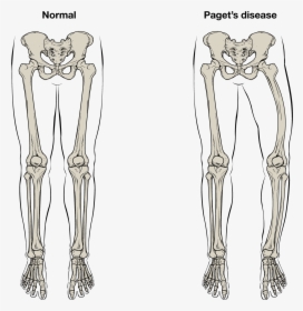 Clip Art Structure Anatomy And - Deformity Paget's Disease Bone, HD Png Download, Free Download