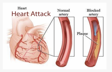 Heart Attack, Heart Attack - Blocked Coronary Artery, HD Png Download, Free Download