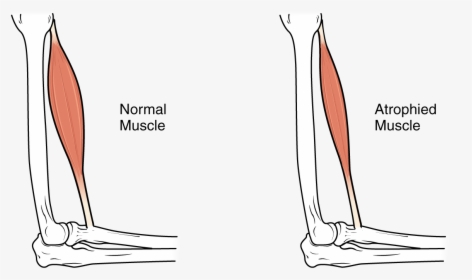 This Image Shows Muscle Atrophy - Muscles Atrophy, HD Png Download, Free Download