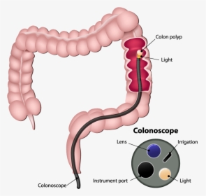 Colonoscopy, HD Png Download, Free Download