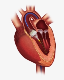 Heart Valve Replacement - Transcatheter Aortic Valve Replacement, HD Png Download, Free Download