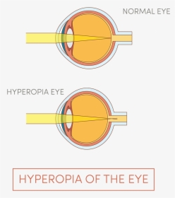 Illustration Of Human Eye - Hyperopia, HD Png Download, Free Download