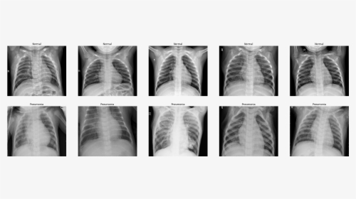 X Ray Of Pneumonia, HD Png Download, Free Download