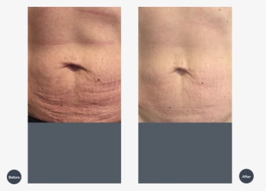 Tixel For Stretch Marks Before After, HD Png Download, Free Download