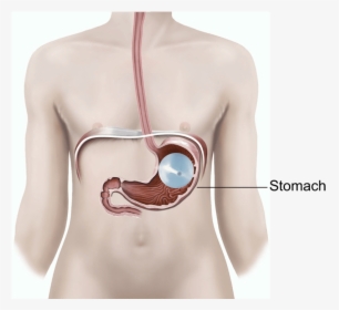 Illustration Showing A Gastric Balloon In The Stomach - Gastric Balloon, HD Png Download, Free Download