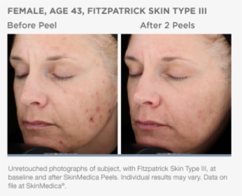 Face Scar Png -vitalize Peel Beforeafter - 1 Vitalize Face Peel, Transparent Png, Free Download