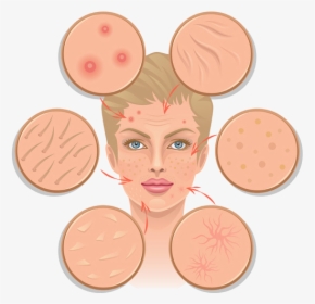 Treat Acne Scars - Scars On Skin Illustration, HD Png Download, Free Download