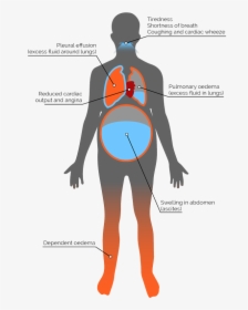 Heart Failure Signs And Symptoms, HD Png Download, Free Download