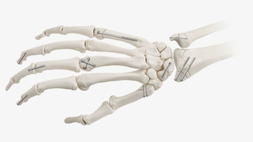 Captivate® Screws In Hand - Skeleton, HD Png Download, Free Download