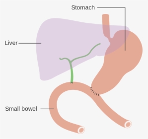 Total Pancreatectomy And Splenectomy, HD Png Download, Free Download