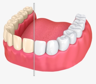 Tooth Discoloration, HD Png Download, Free Download