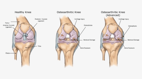 Osteoarthritis Knee Joint - Total Knee Replacement Causing Osteoarthritis, HD Png Download, Free Download