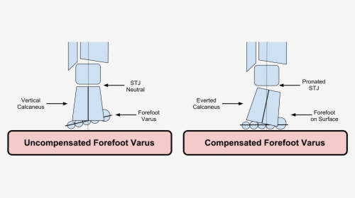 Compensated Vs Uncompensated Forefoot Varus, HD Png Download, Free Download