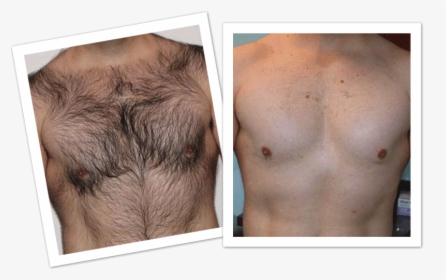 Mens Laser Hair Removal Before And After, HD Png Download, Free Download