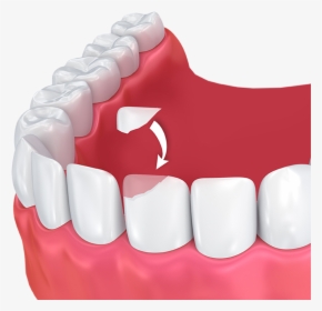 Google Tooth Bonding Illustration, HD Png Download, Free Download