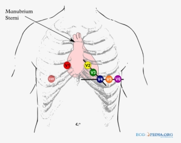 Brugada Syndrome Ecg Placement, HD Png Download, Free Download