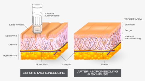 Cross Section@2x-1024x540 - Microneedling Works, HD Png Download, Free Download