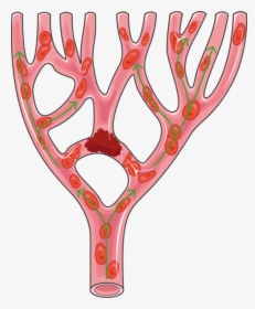 Thrombus Png, Transparent Png, Free Download