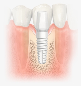 Dental Implant, HD Png Download, Free Download