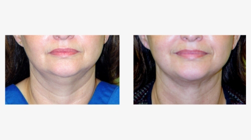 Chin Liposuction Before And After , Png Download - Close-up, Transparent Png, Free Download