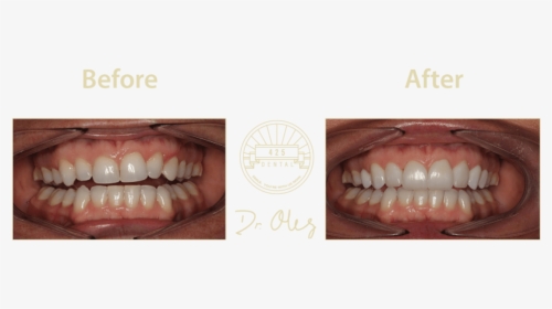 425 Before After Cosmetic38 - Tongue, HD Png Download, Free Download