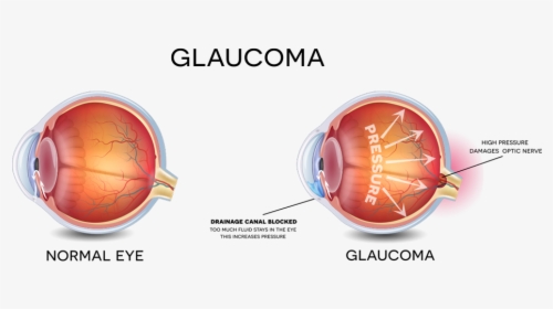 Glaucoma - Eye Glaucoma, HD Png Download, Free Download