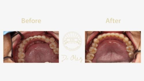 425 Before After Invisaline25 - Dentistry, HD Png Download, Free Download