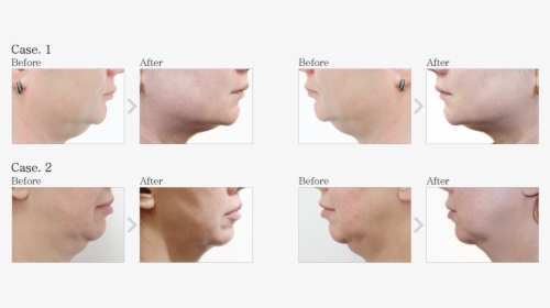 Dermaheal Ll Before And After, HD Png Download, Free Download