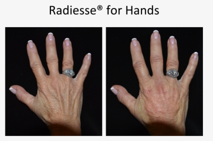 Before And After Radiesse For Hands - Engagement Ring, HD Png Download, Free Download