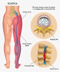 Sciatica Massage, HD Png Download, Free Download