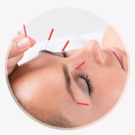 Louisville Acupuncture Treatment - Do They Do Acupuncture For Headaches, HD Png Download, Free Download