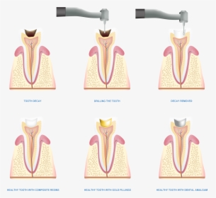 Tooth Filling Illustration - Small Appliance, HD Png Download, Free Download