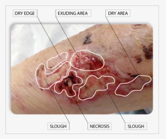 Desiccation Wound, HD Png Download, Free Download