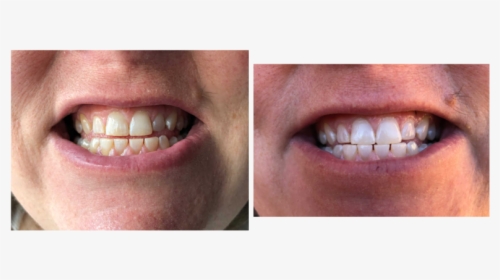 Crest White Strips With Light Before And After, HD Png Download, Free Download